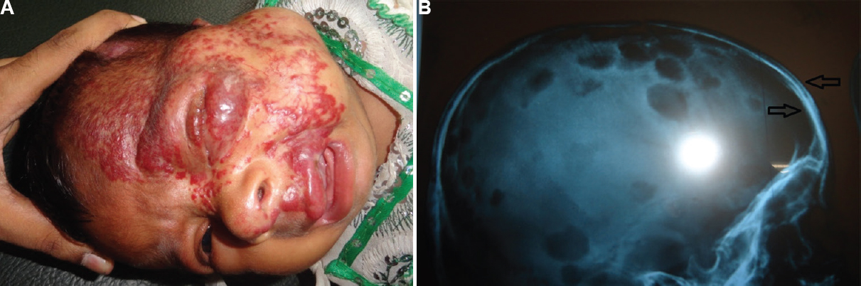 (A) Port-wine stain affecting the left side of the face, extending up to the scalp. (B) X-ray of skull showing tram-track appearance (arrow).